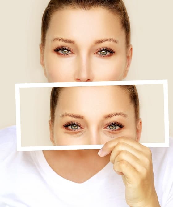 Sacramento blepharoplasty