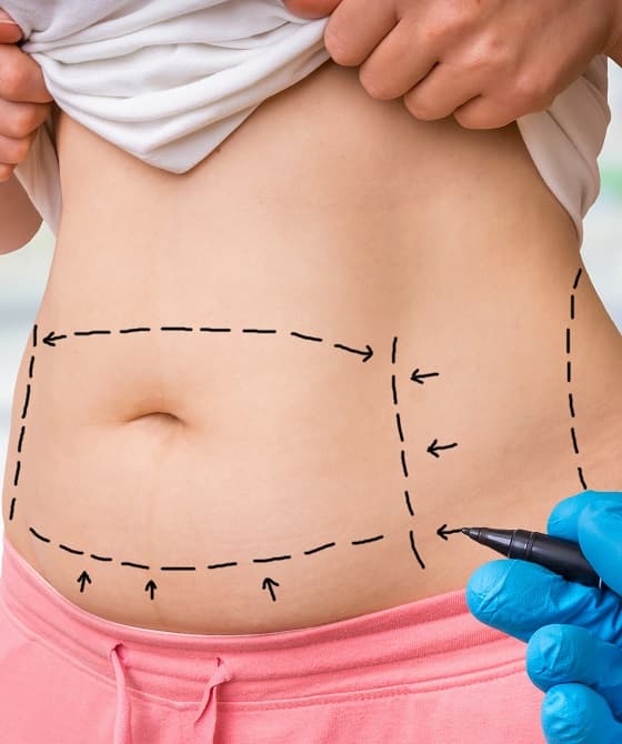 Sacramento liposuction surgeon