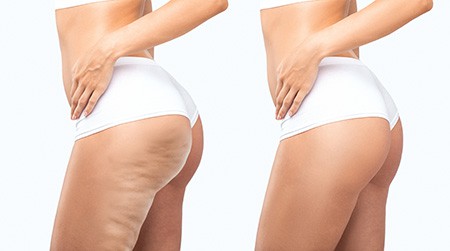 Cellulite reduction Aveli in Sacramento